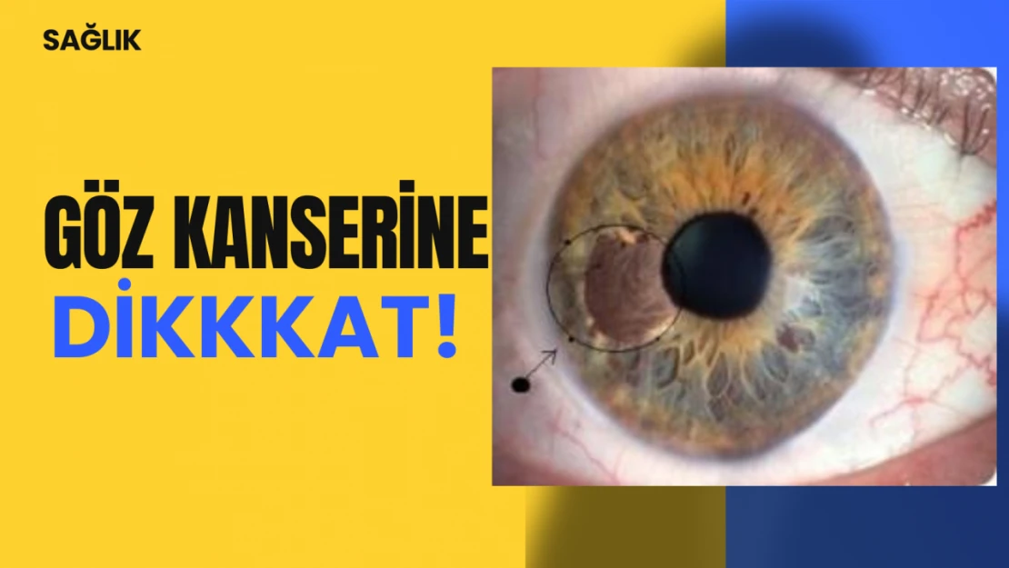 Göz Kanserine Dikkat!