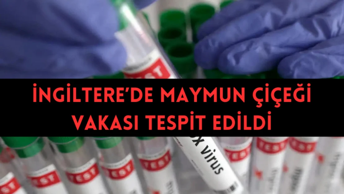 İngiltere'de maymun çiçeği vakası tespit edildi