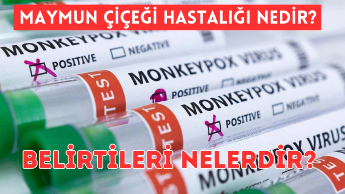 Maymun Çiçeği hastalığı nedir, belirtileri nelerdir?