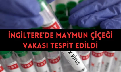 İngiltere'de maymun çiçeği vakası tespit edildi