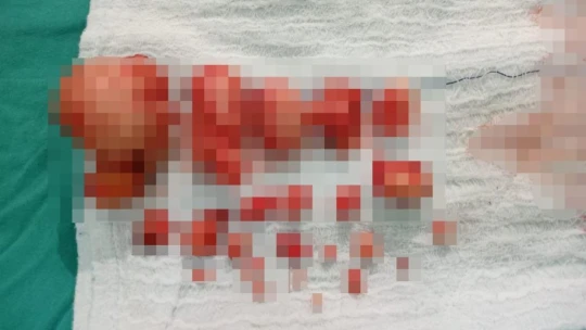 Ağrı şikayetiyle hastaneye gitti, rahim duvarından 23 miyom çıkarıldı