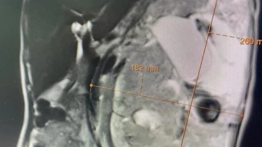 Korona virüs sayesinde 30 santimlik tümöründen kurtuldu