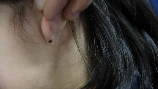 Kulağına kene yapışan küçük çocuk hastaneye kaldırıldı