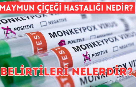 Maymun Çiçeği hastalığı nedir, belirtileri nelerdir?