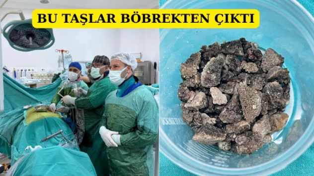 Bu taşlar böbrekten çıktı
