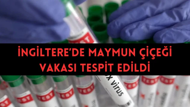 İngiltere'de maymun çiçeği vakası tespit edildi