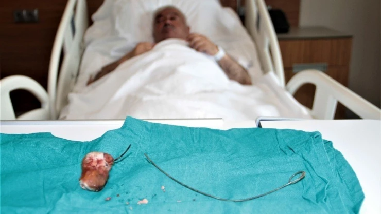 Unutulan 28 santimlik 'stent' 7 yıl sonra fark edildi