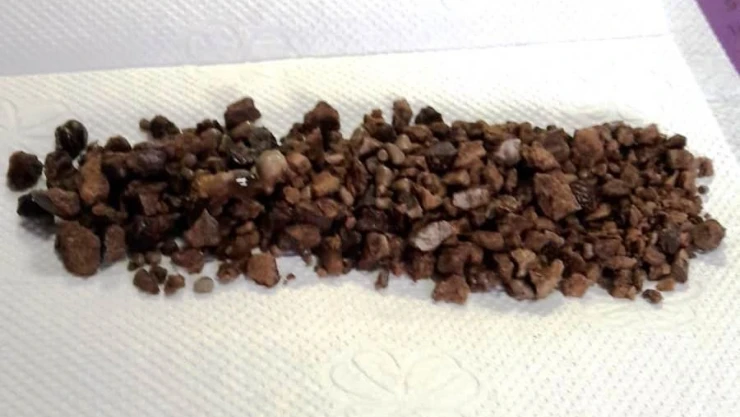 Böbreklerinde 500 adet taş çıktı