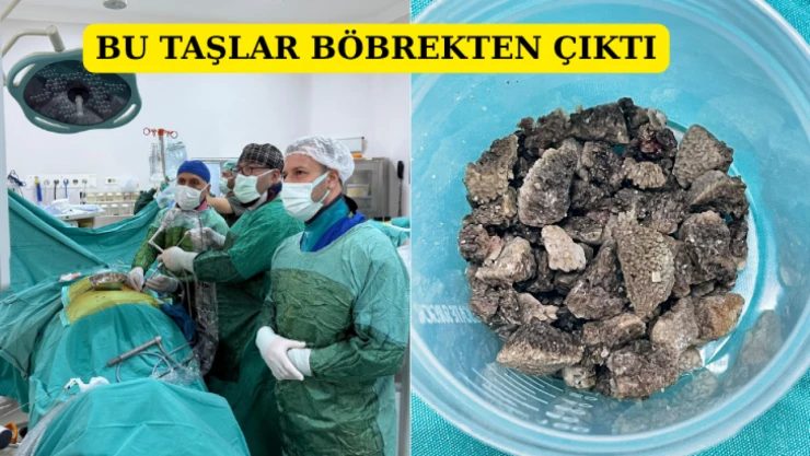 Bu taşlar böbrekten çıktı