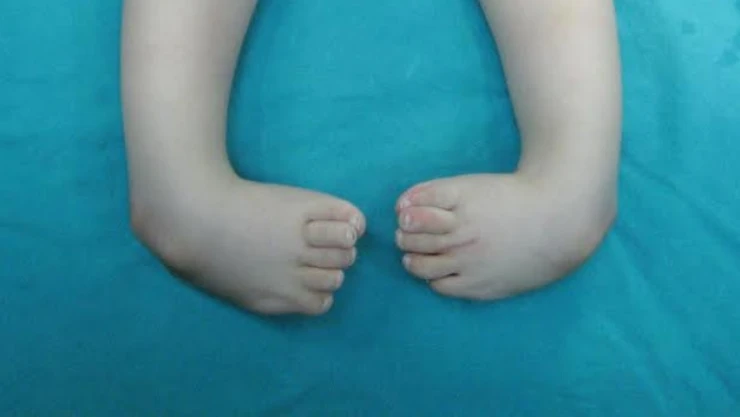 Çarpık ayak sorununun tedavisi mümkün