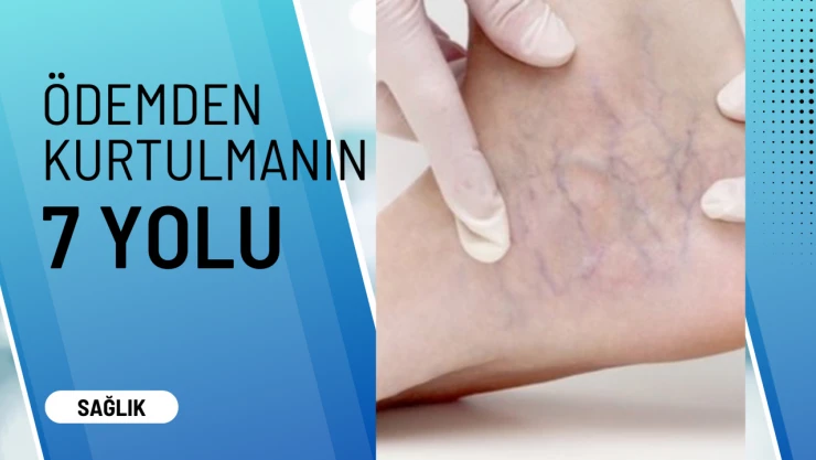 Ödemden kurtulmanın 7 yolu